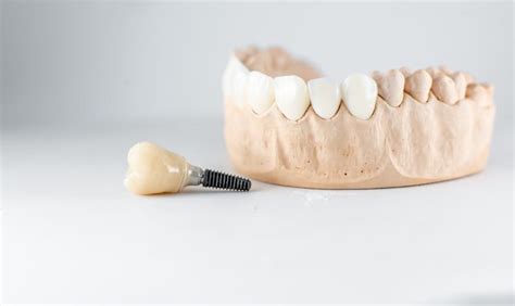 gorda dental|punta gorda dental implants.